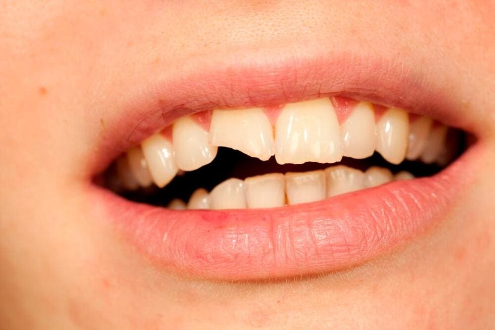 boca con diente roto