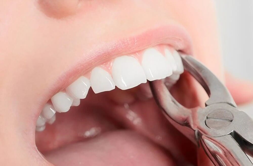 extracción dental boca paciente
