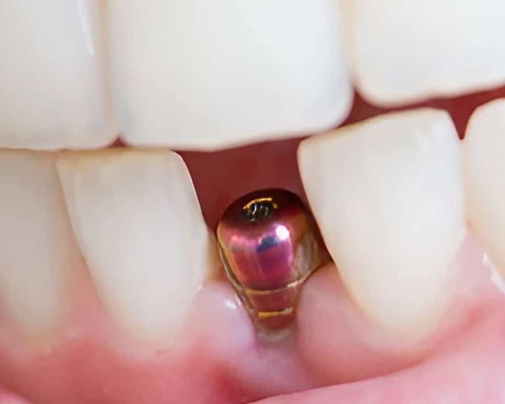 protésico dental para diente