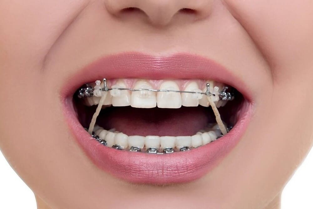 elásticos ortodoncia