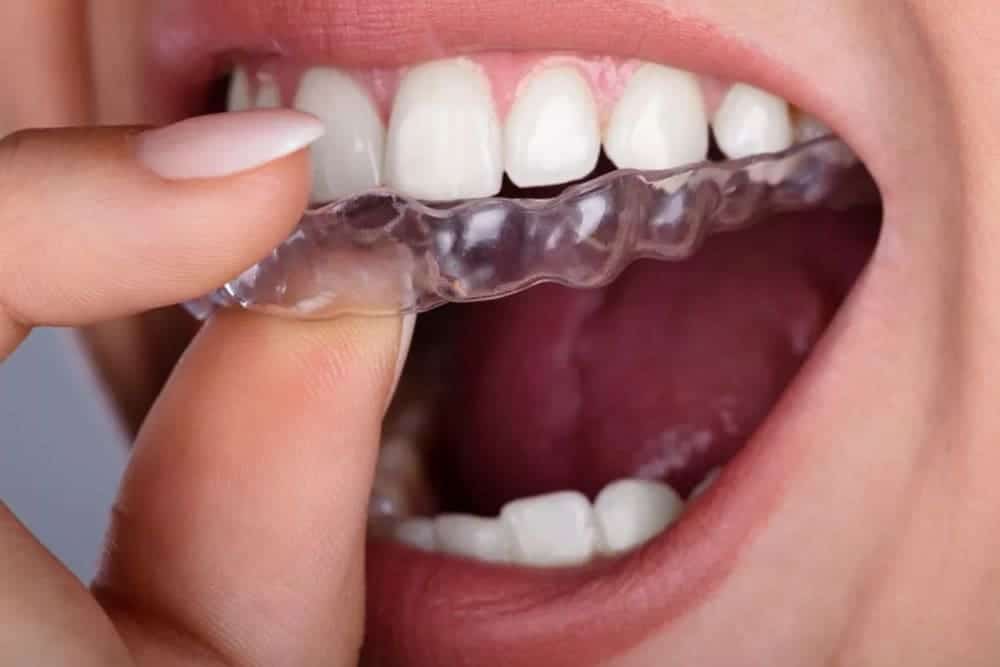 persona colocándose odontología invisible