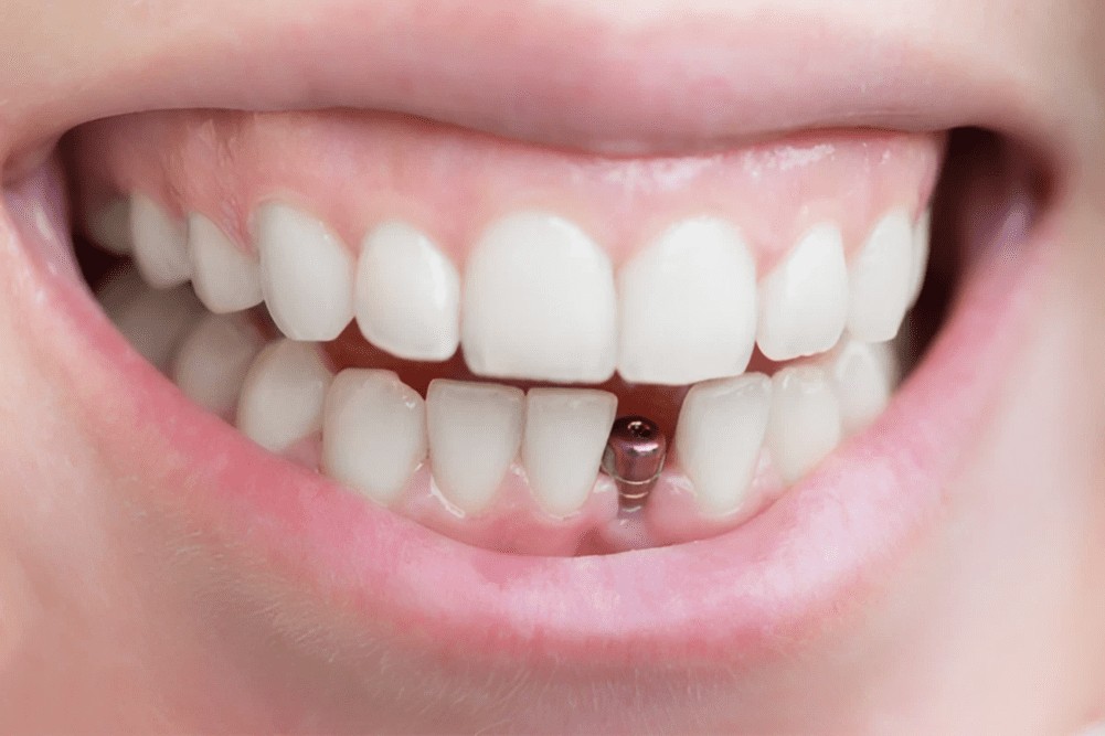 sonrisa mujer mostrando su prótesis dental fija