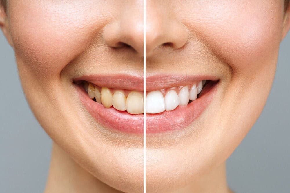 sonrisa paciente con blanqueamiento antes y después