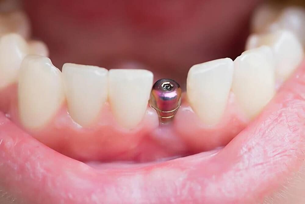 vista cenital tornillo diente post implante